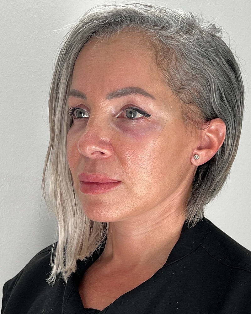 Facelift Before & After