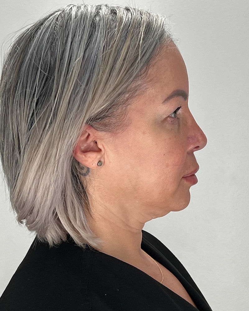 Facelift Before & After