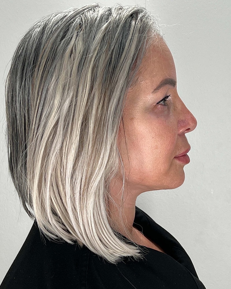 Facelift Before & After