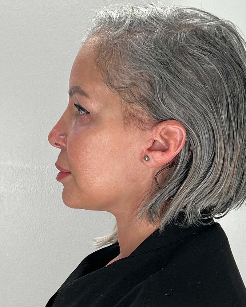Facelift Before & After