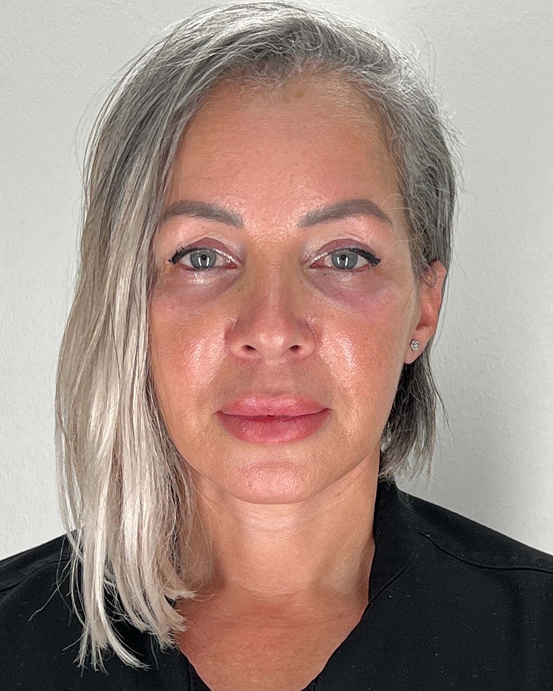 Facelift Before & After