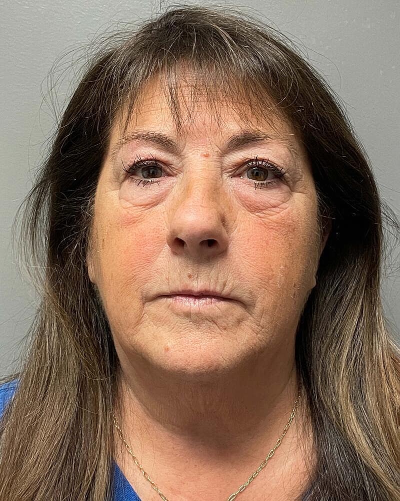 Facelift Before & After