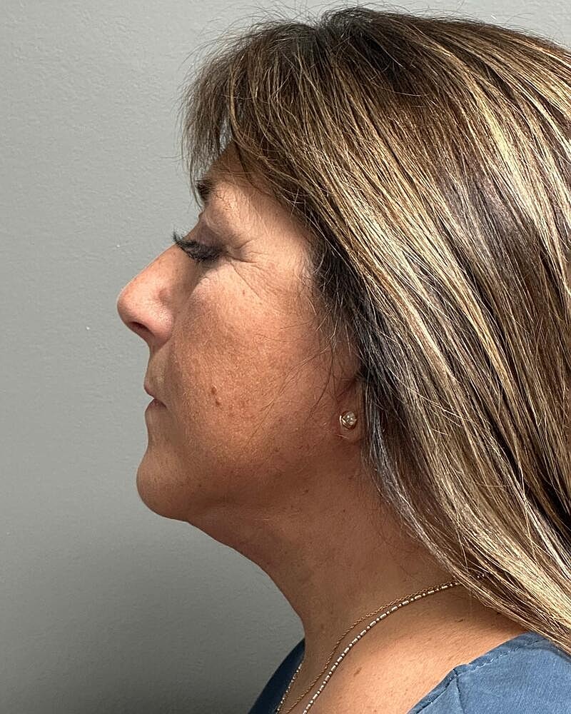 Facelift Before & After