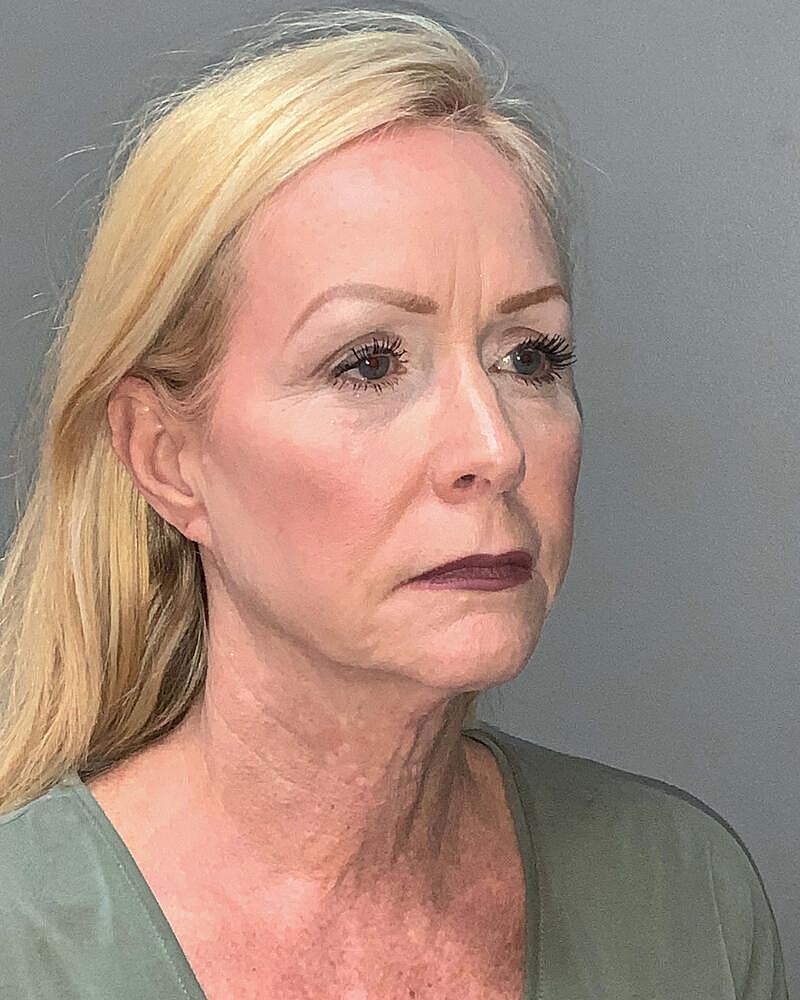 Facelift Before & After