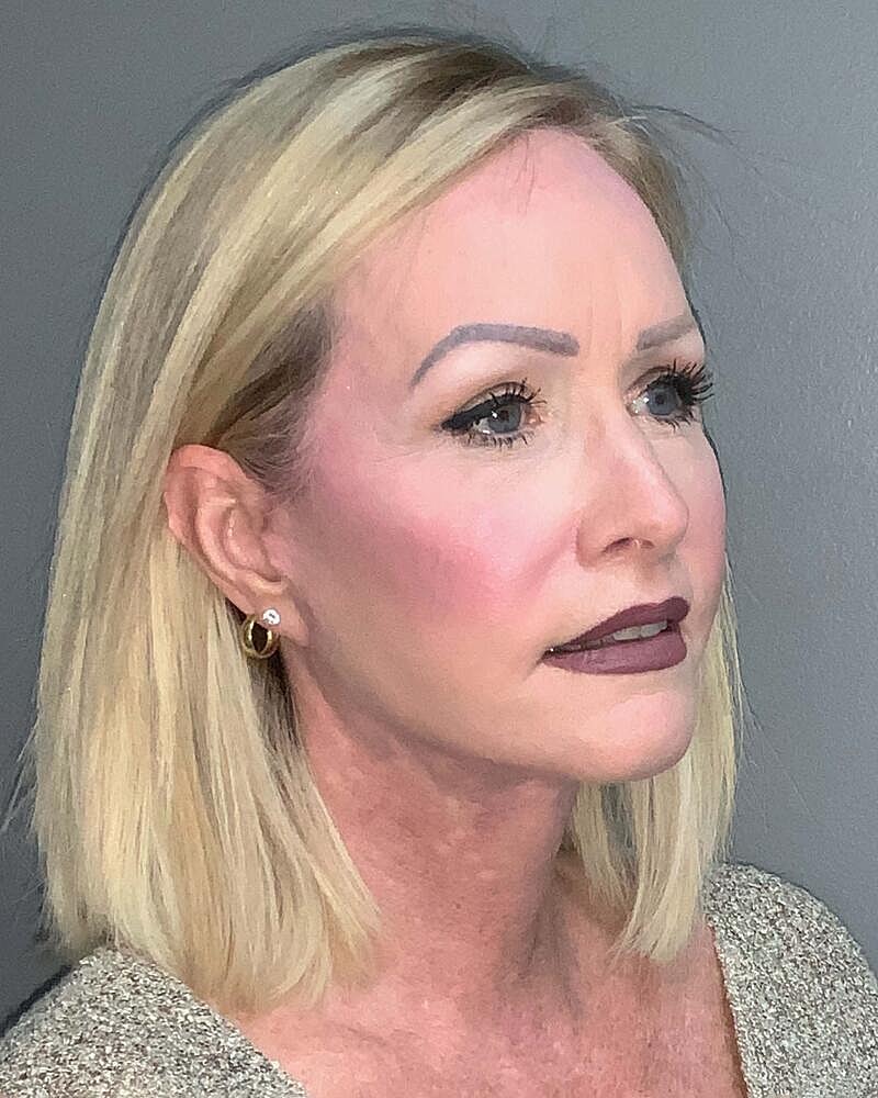 Facelift Before & After