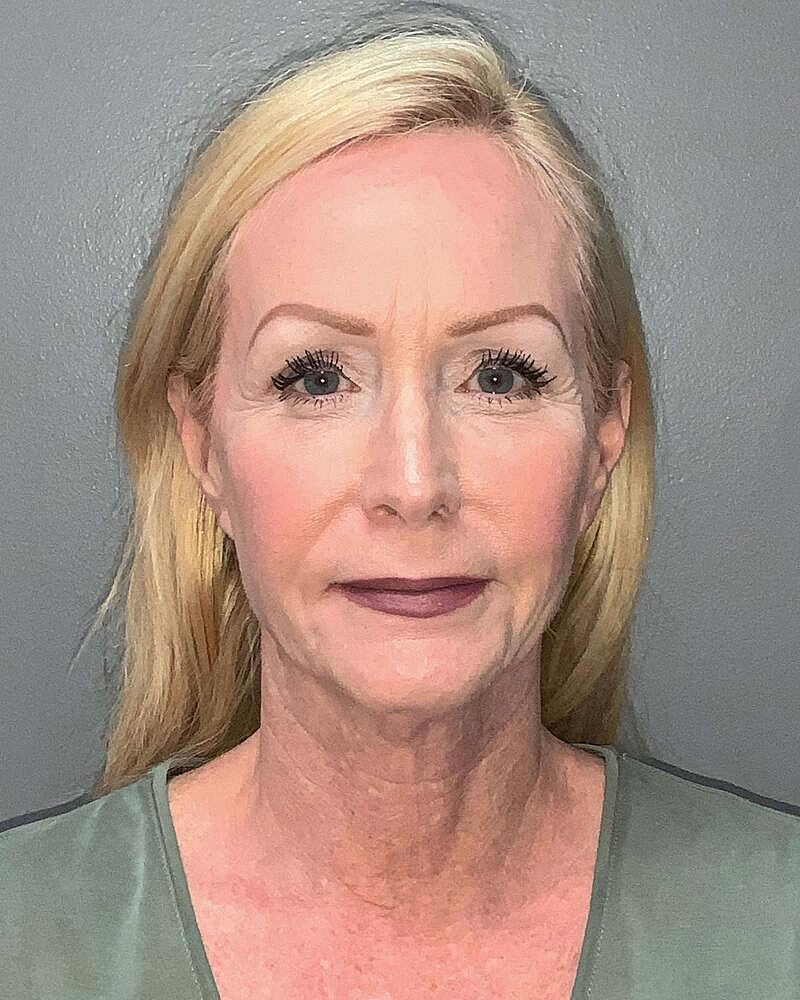 Facelift Before & After