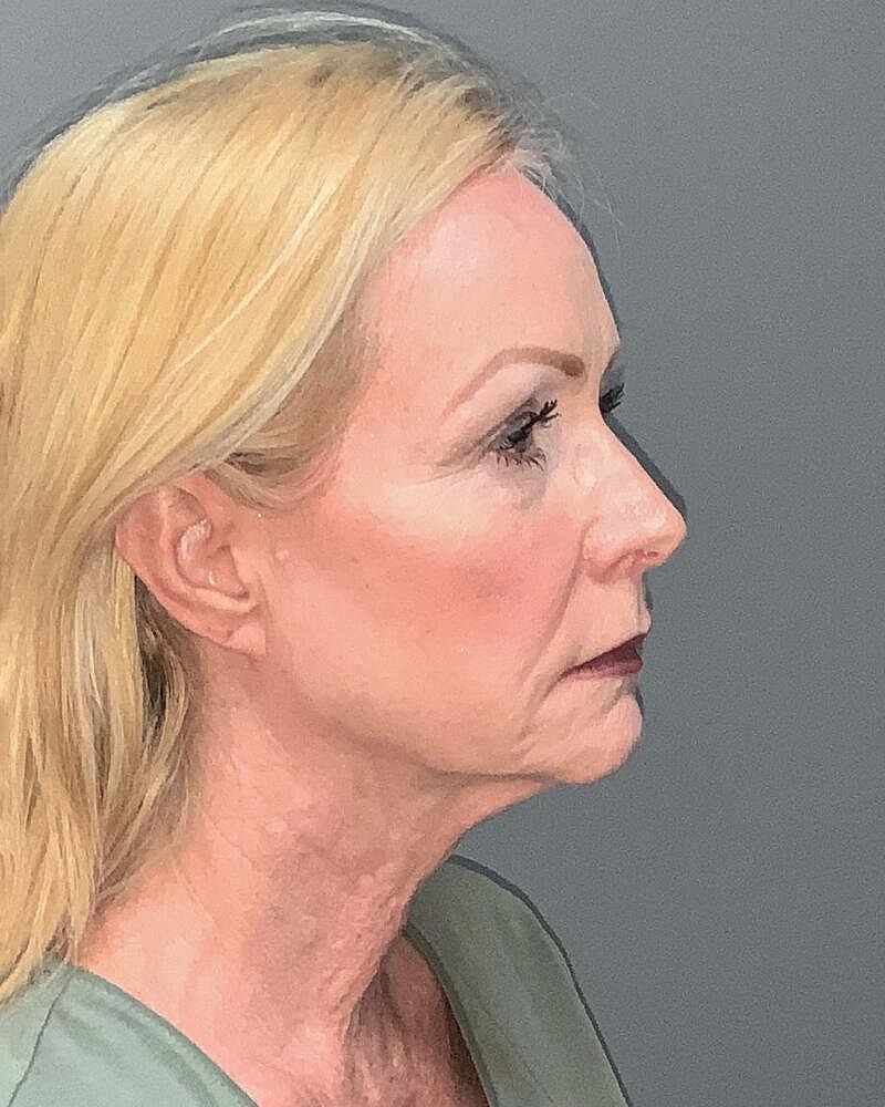 Facelift Before & After