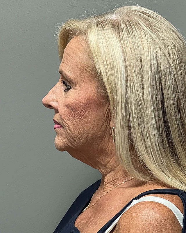 Facelift Before & After