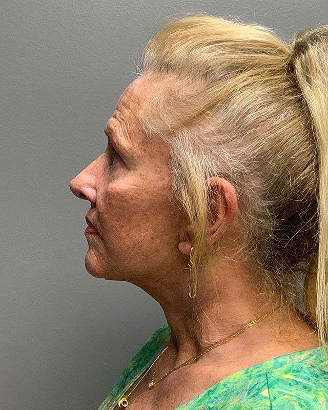 Facelift Before & After