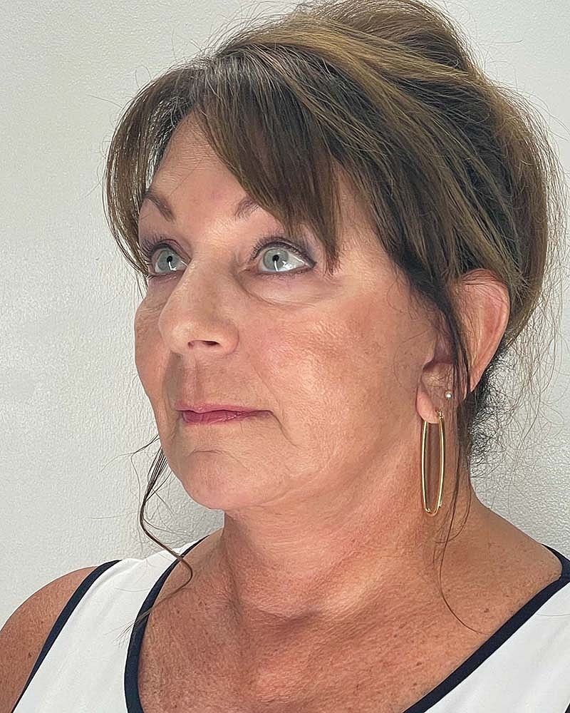 Facelift Before & After