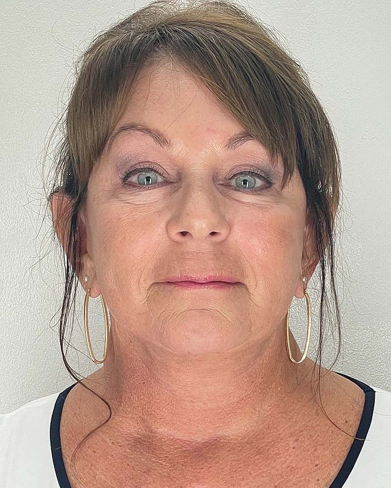 Facelift Before & After
