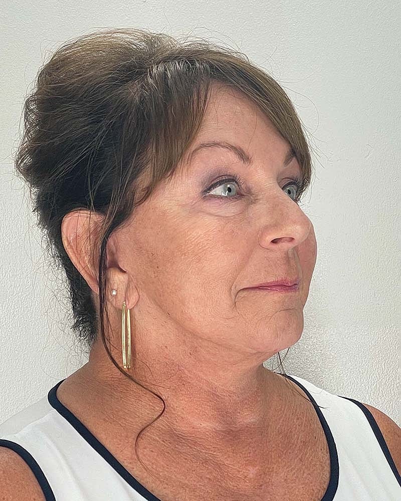 Facelift Before & After