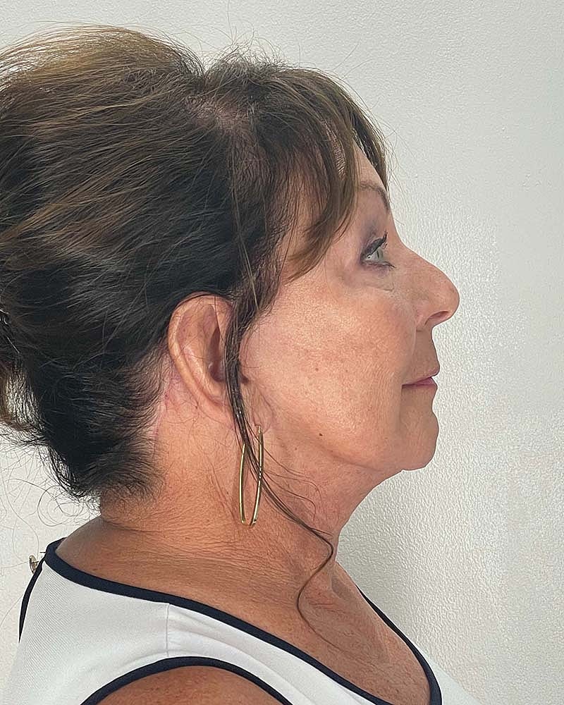 Facelift Before & After