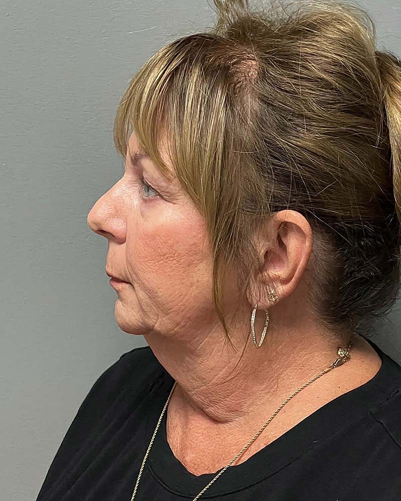 Facelift Before & After