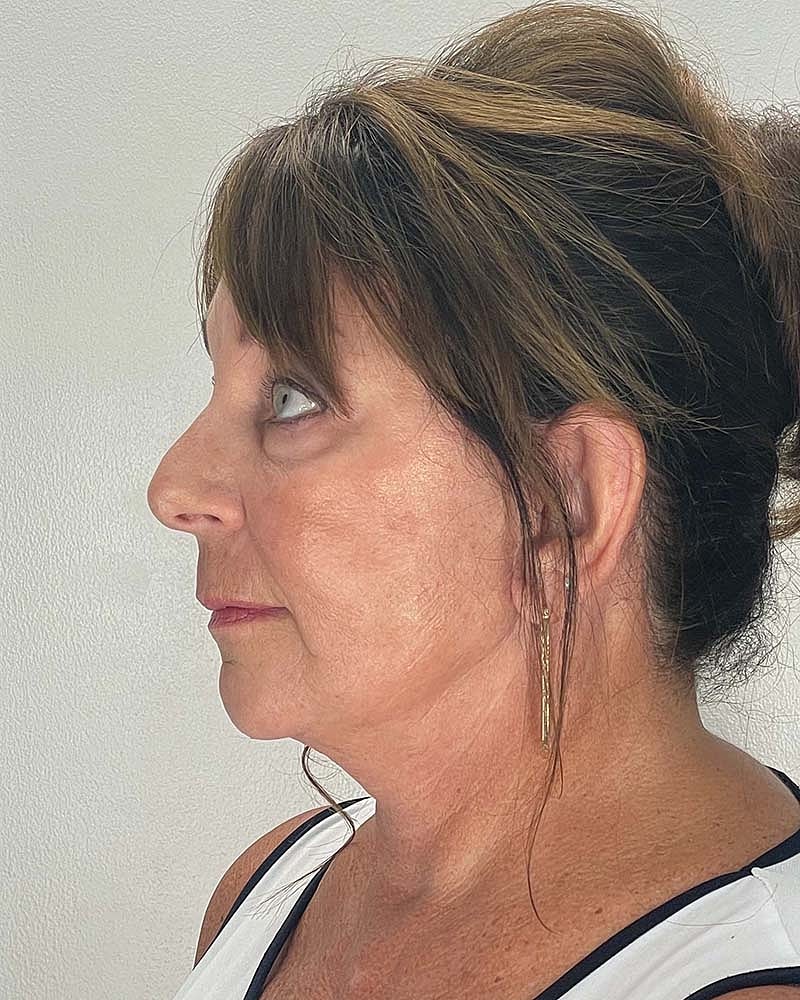 Facelift Before & After