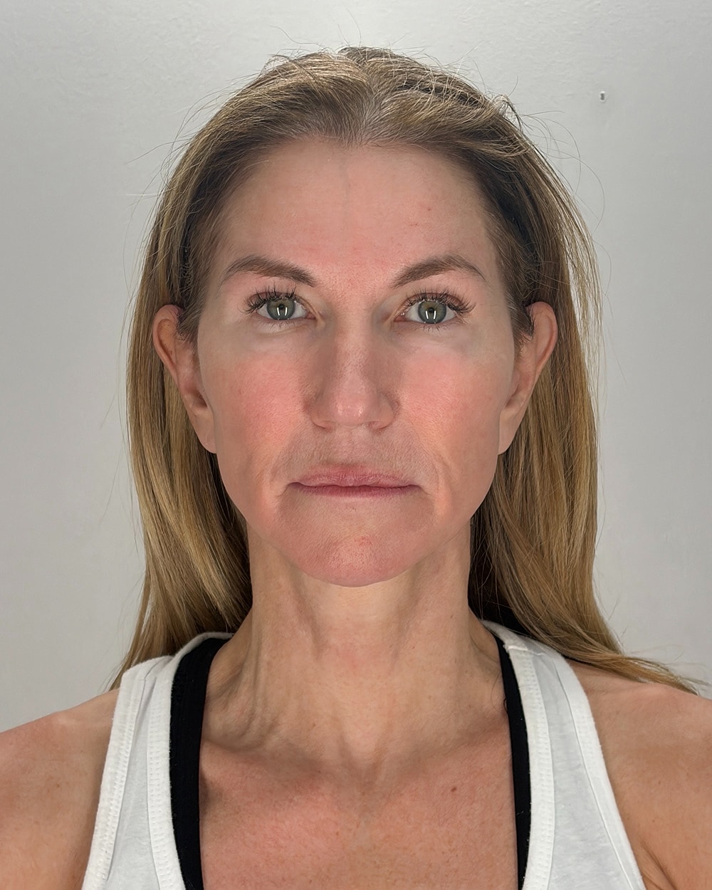 Facelift Gallery Before & After