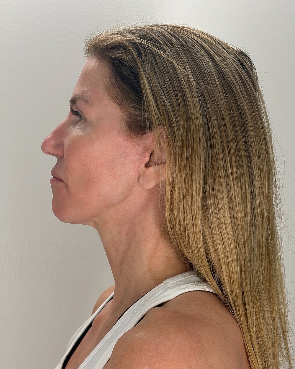 Facelift Gallery Before & After