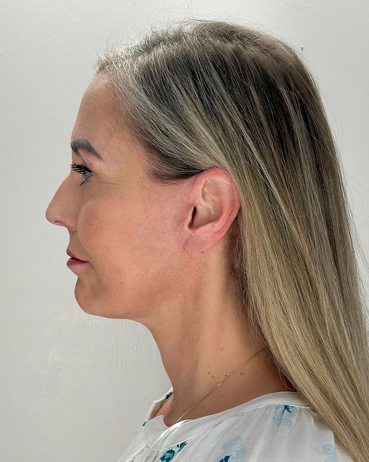 Facelift Gallery Before & After