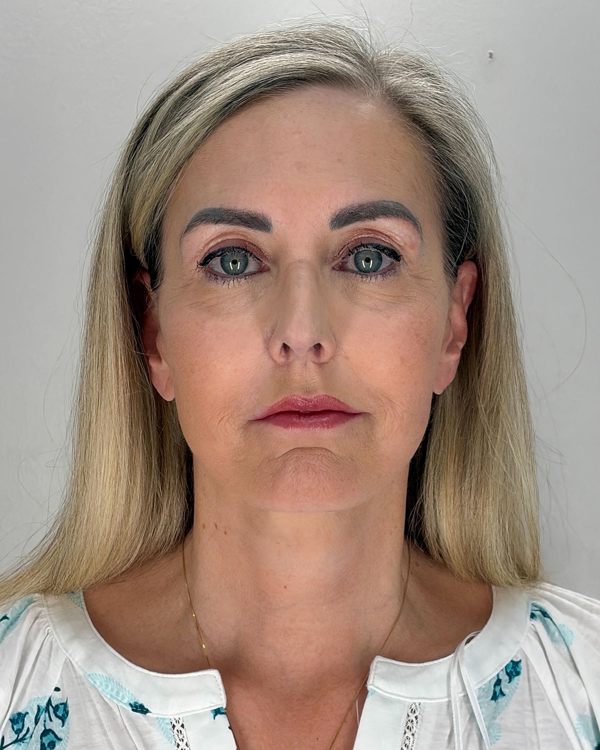 Facelift Gallery Before & After