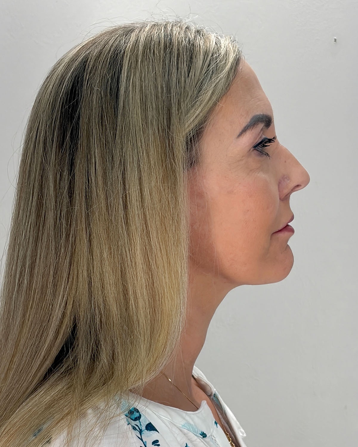Facelift Gallery Before & After