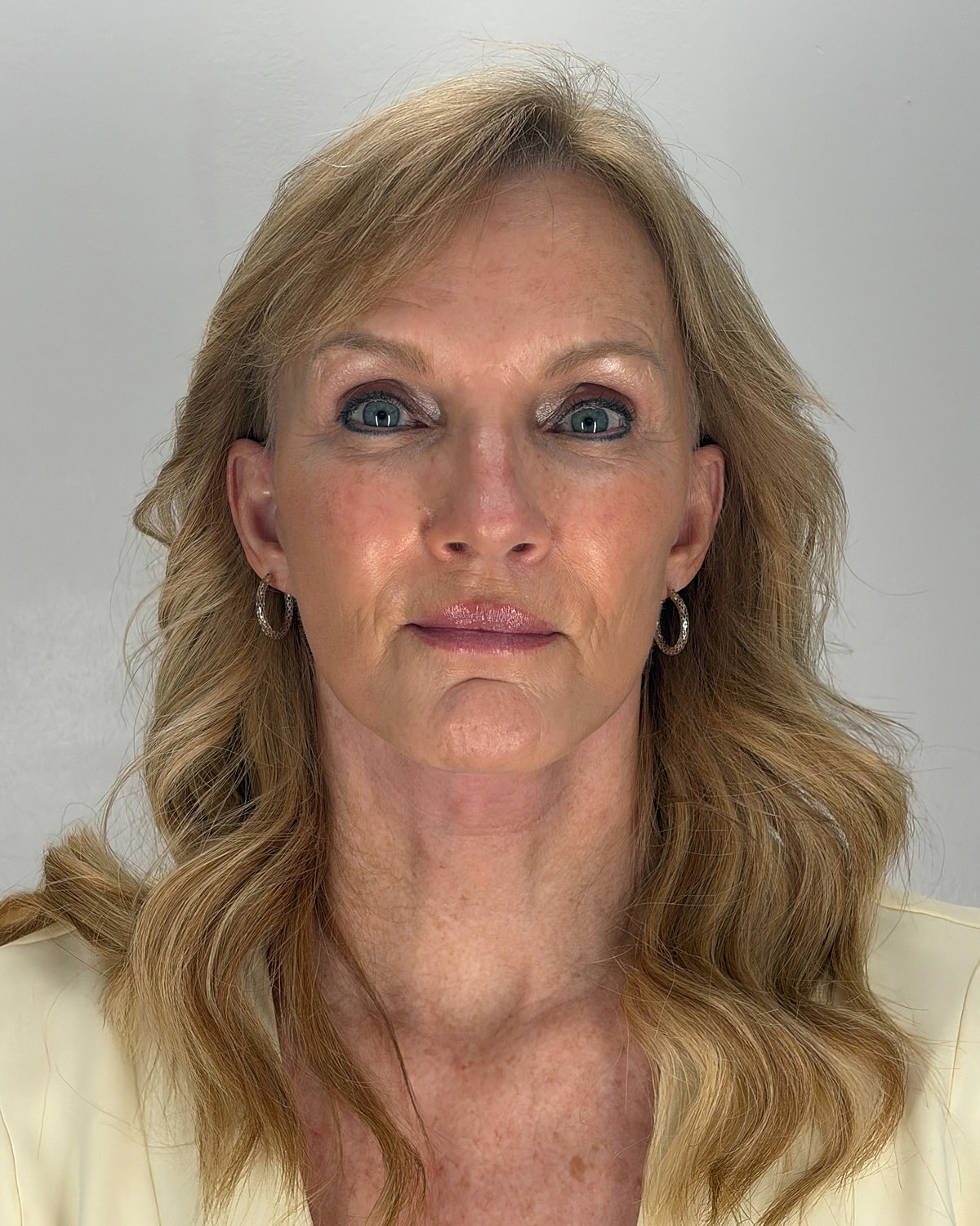 Facelift Gallery Before & After