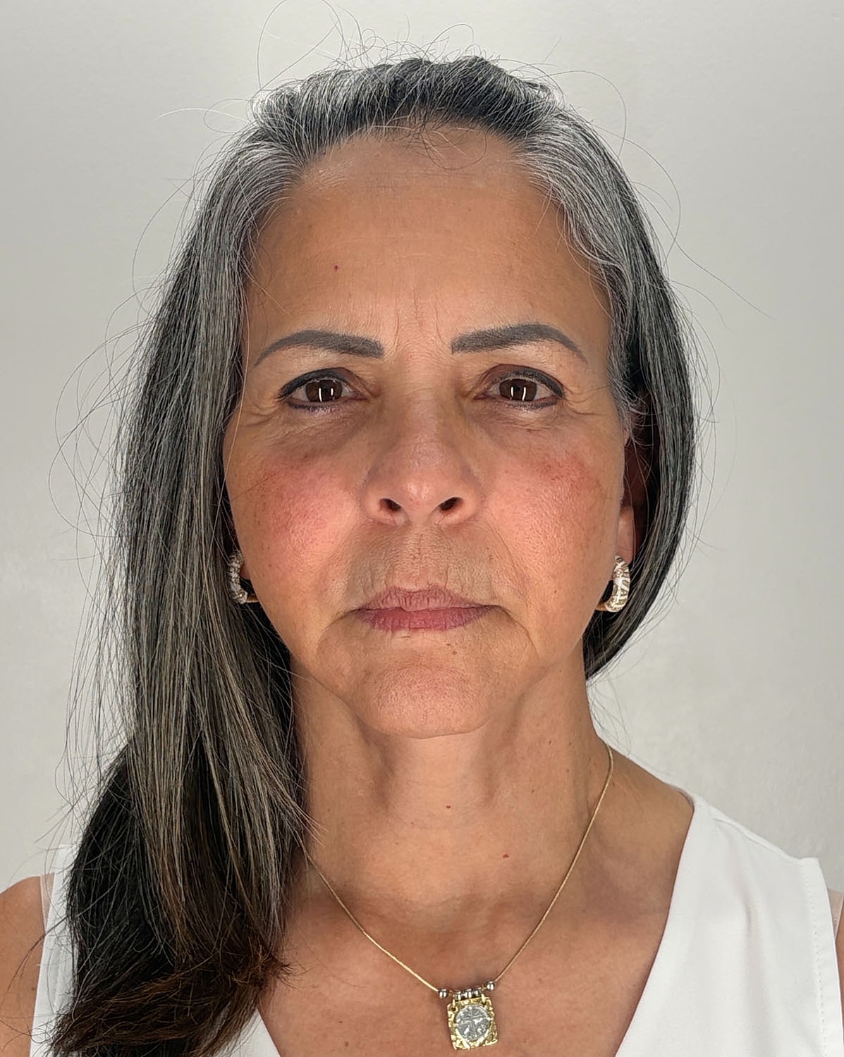 Brow Lift Before & After