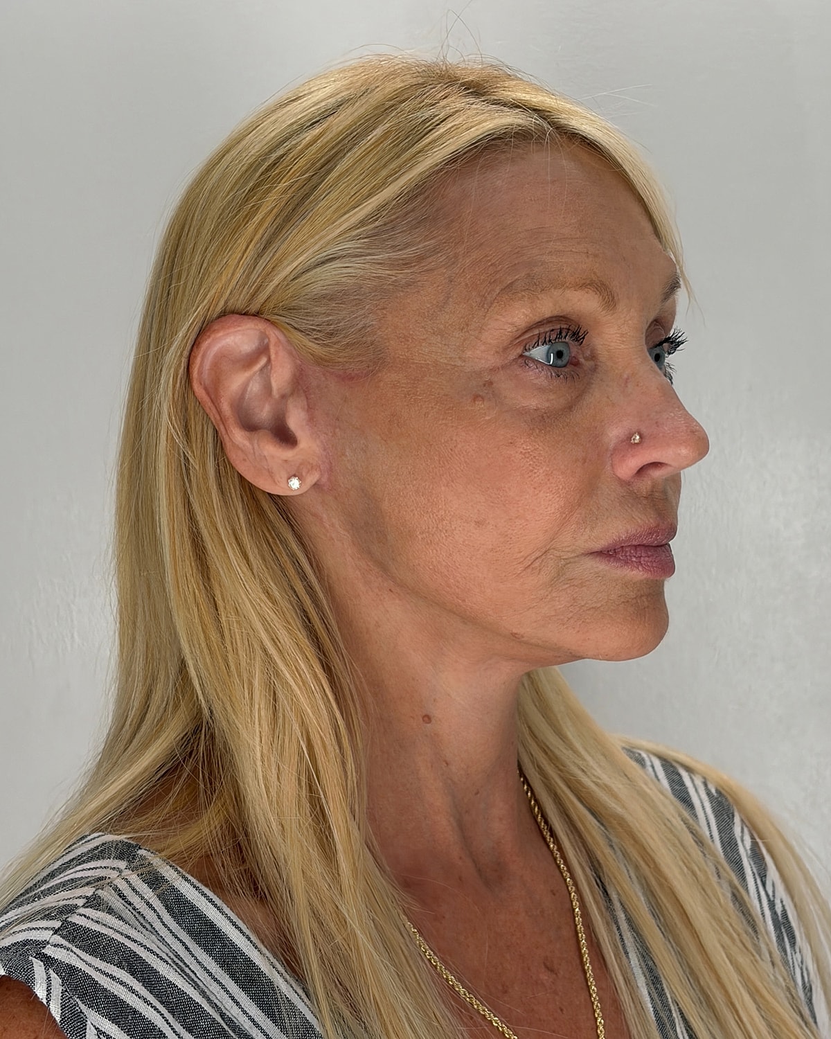 Facelift Gallery Before & After