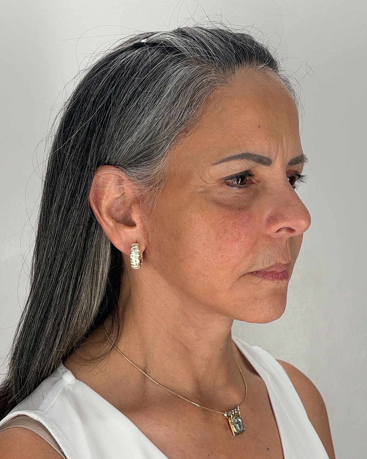 Brow Lift Before & After