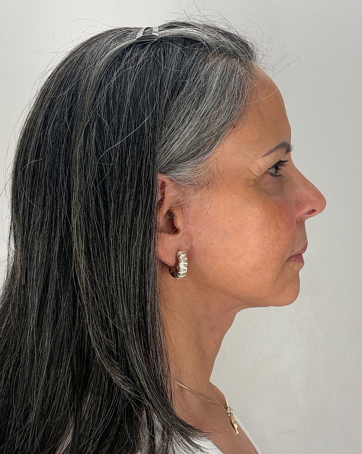 Brow Lift Before & After