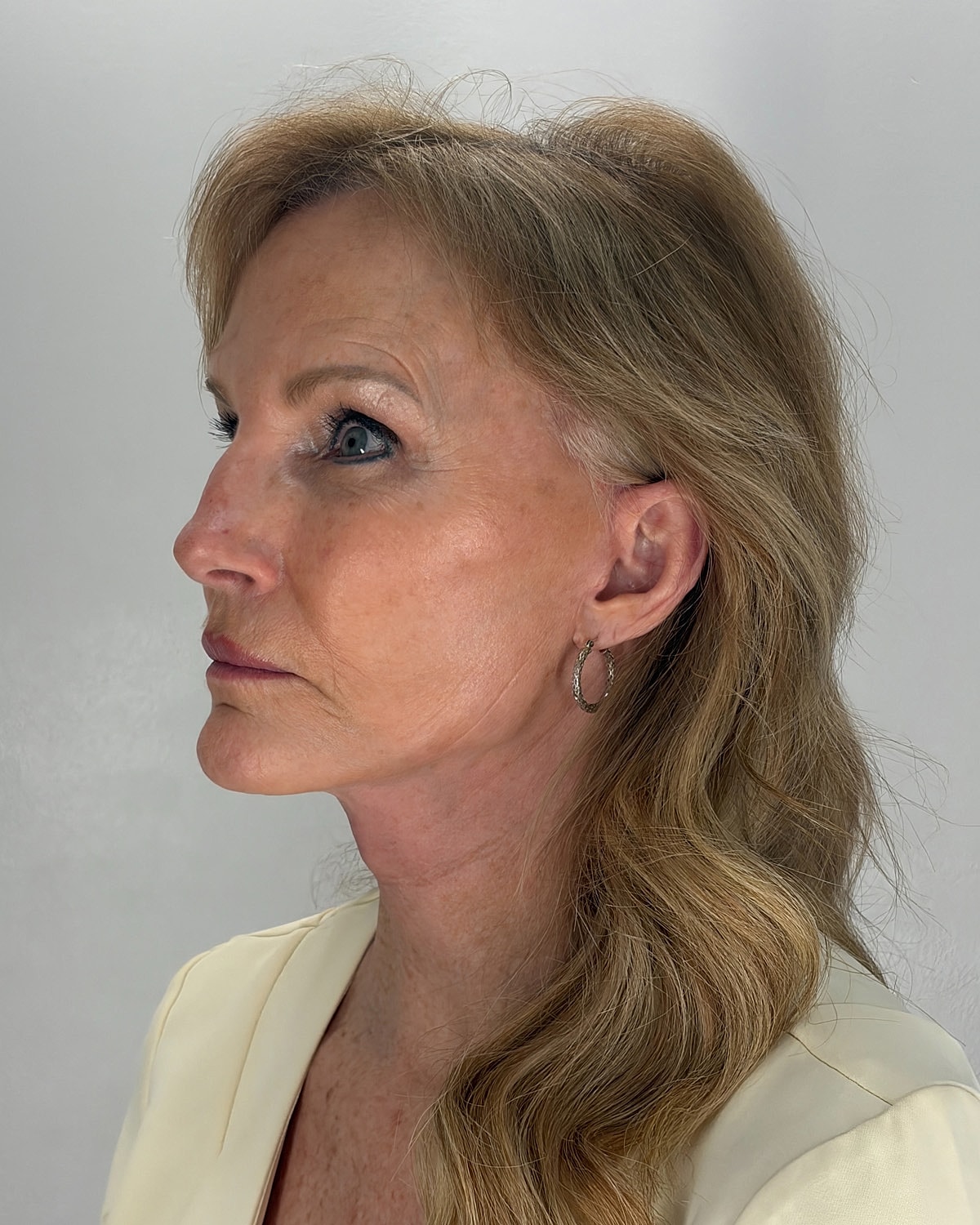 Facelift Gallery Before & After
