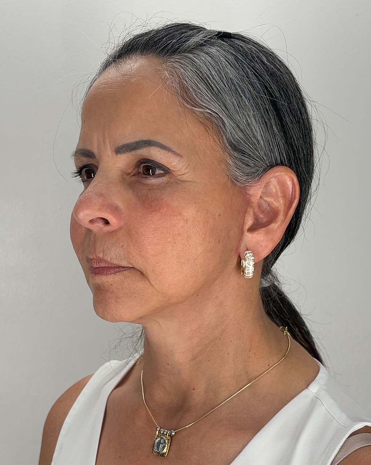 Brow Lift Before & After