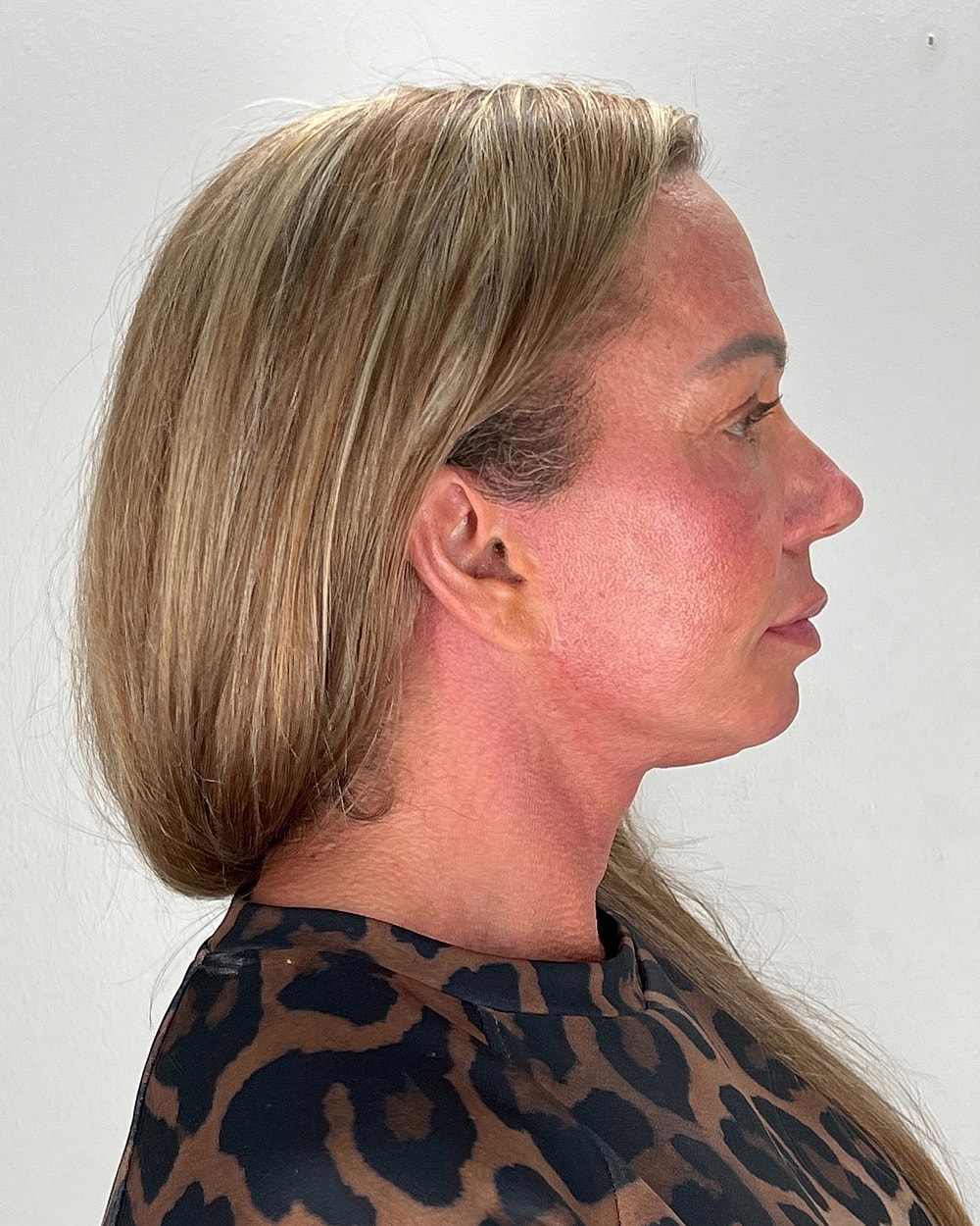 Facelift Gallery Before & After