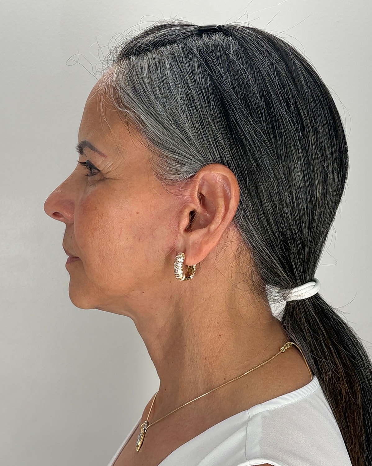 Brow Lift Before & After