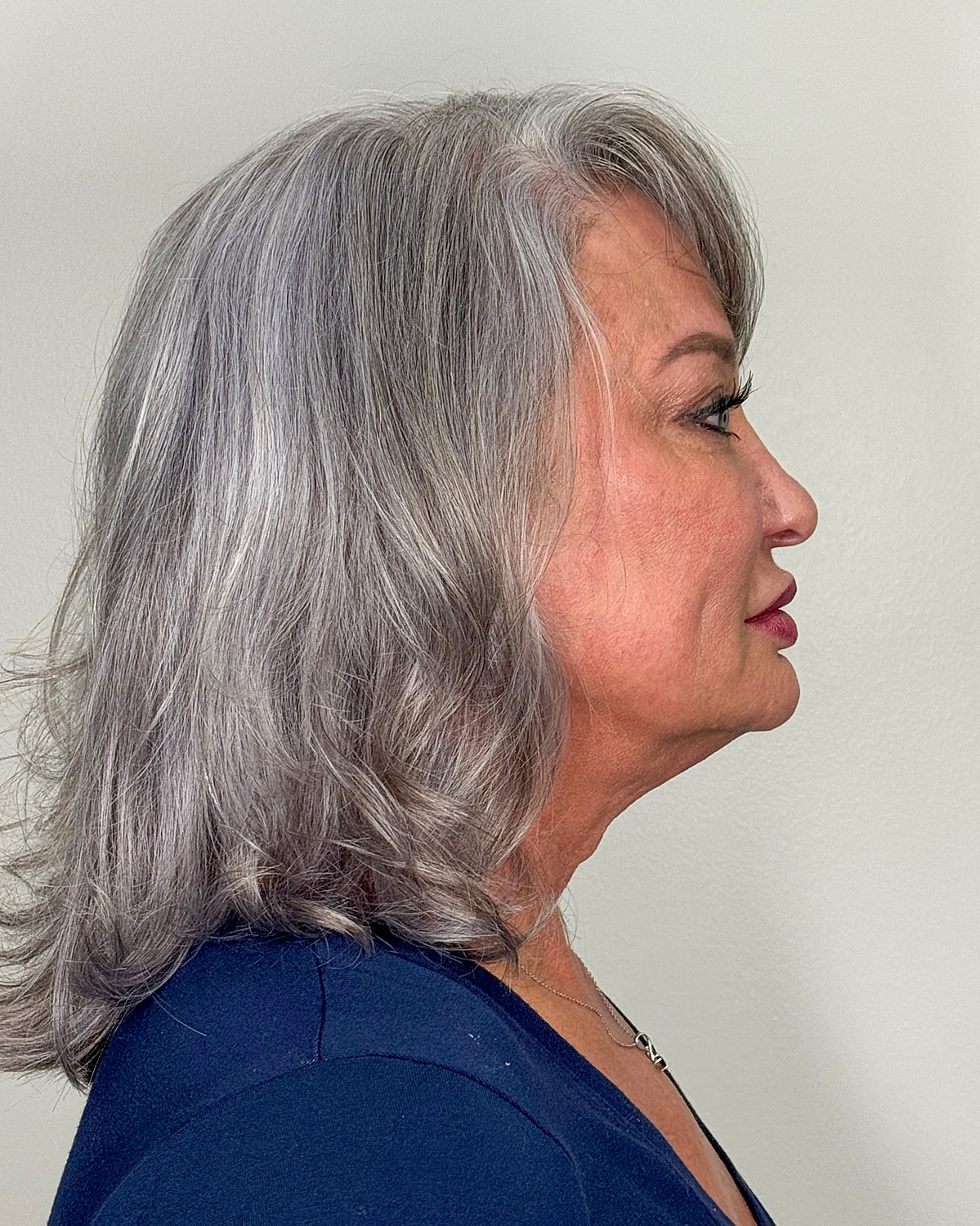 Facelift Gallery Before & After