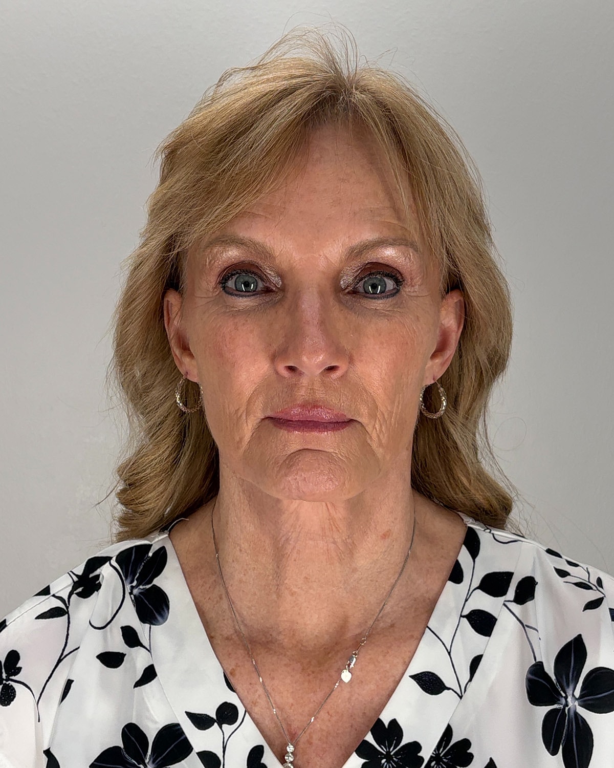 Facelift Gallery Before & After