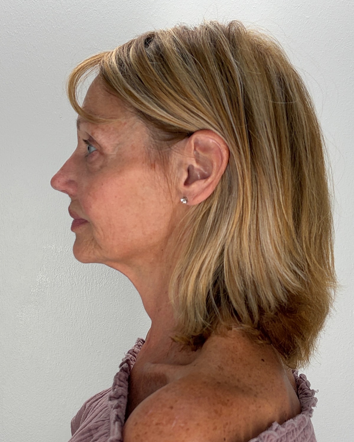 Facelift Gallery Before & After