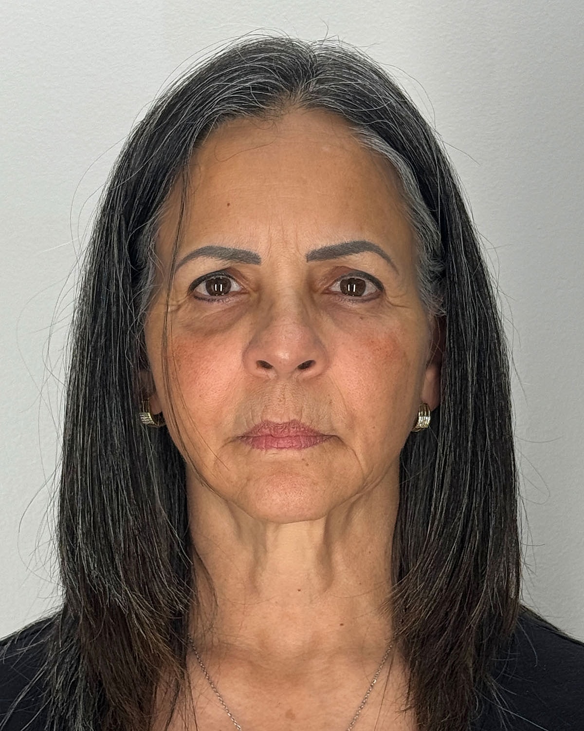 Brow Lift Before & After