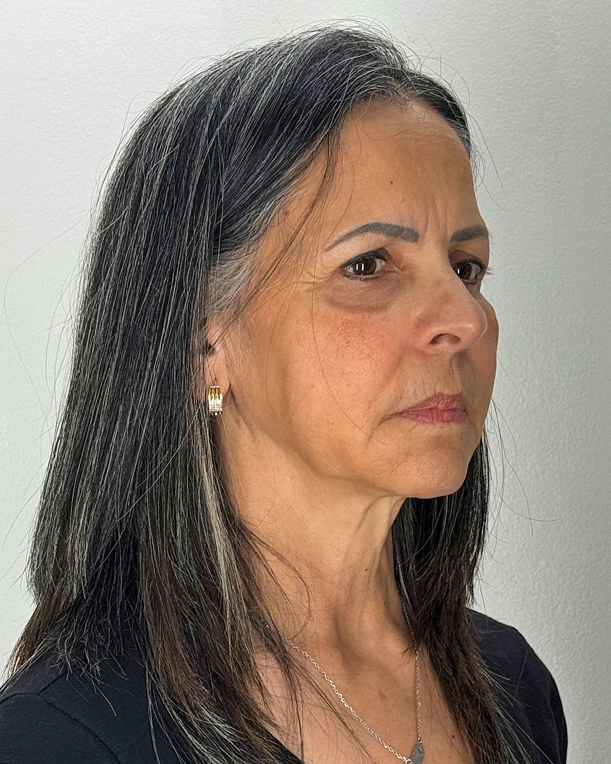 Brow Lift Before & After