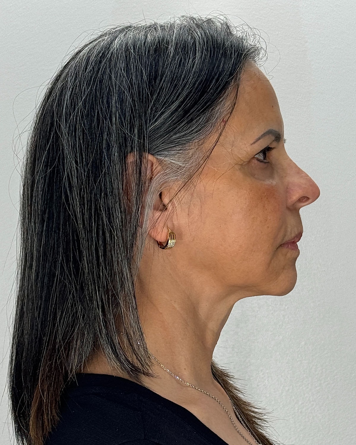 Brow Lift Before & After