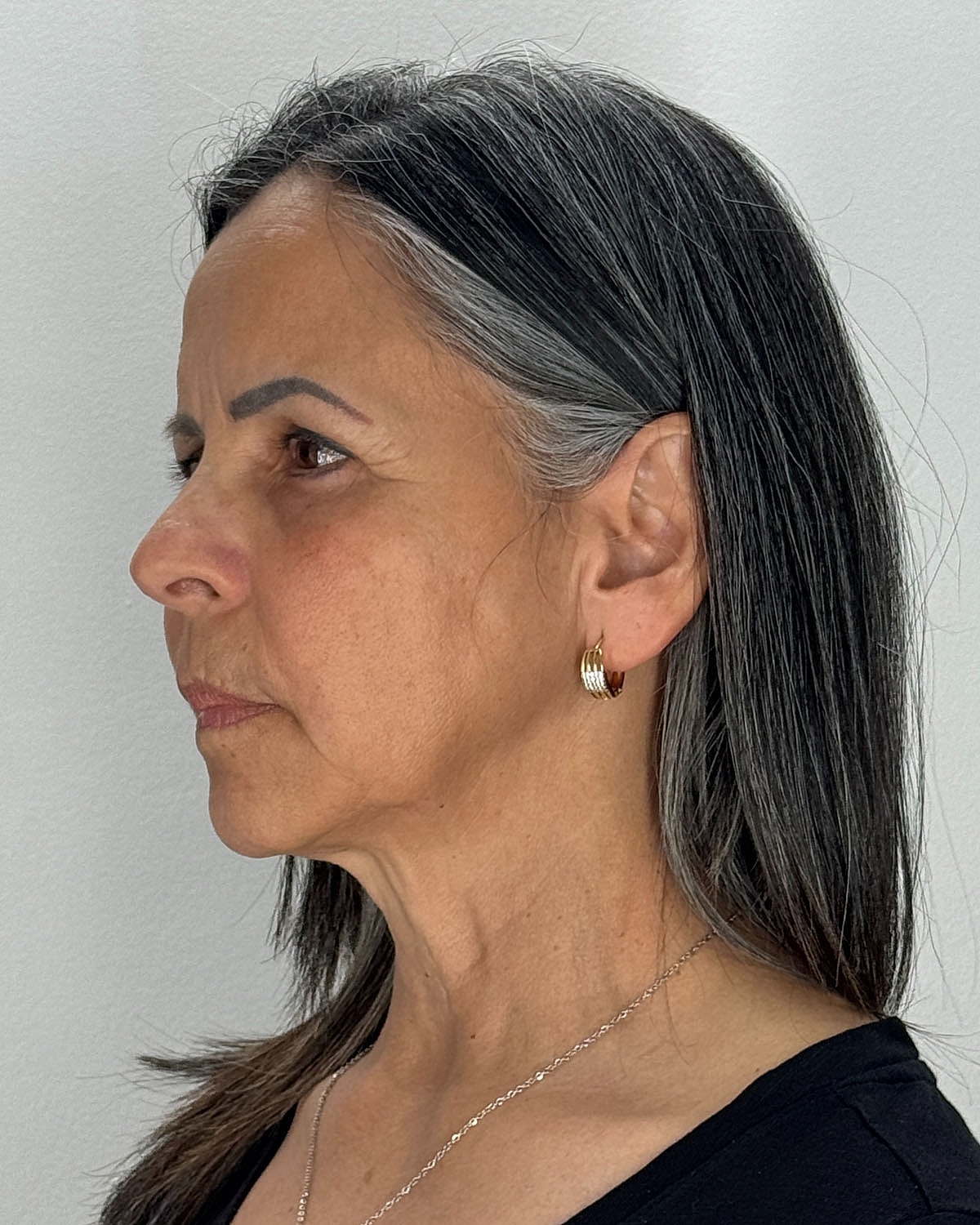 Brow Lift Before & After