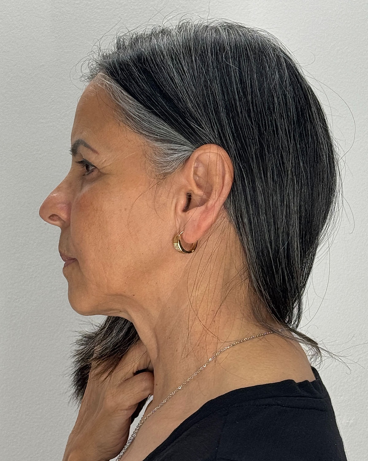 Brow Lift Before & After