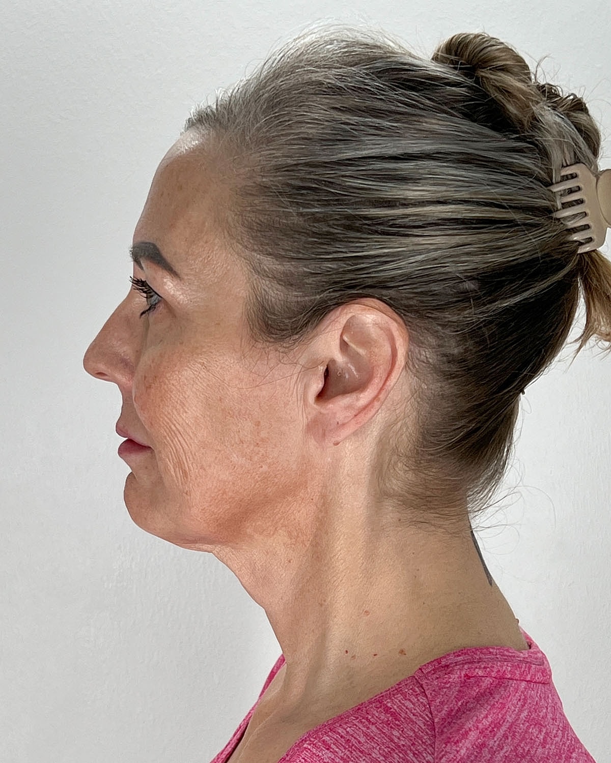 Facelift Gallery Before & After
