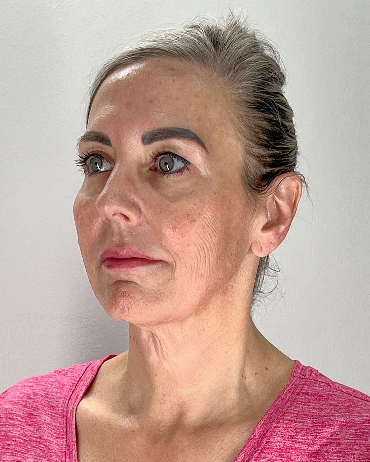 Facelift Gallery Before & After