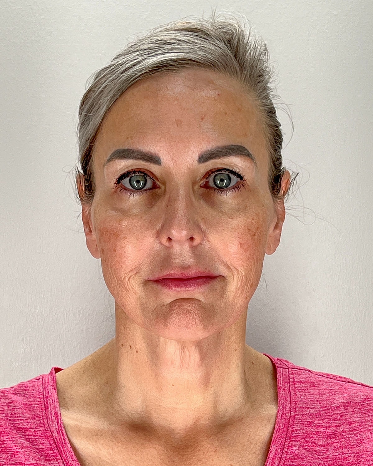 Facelift Gallery Before & After