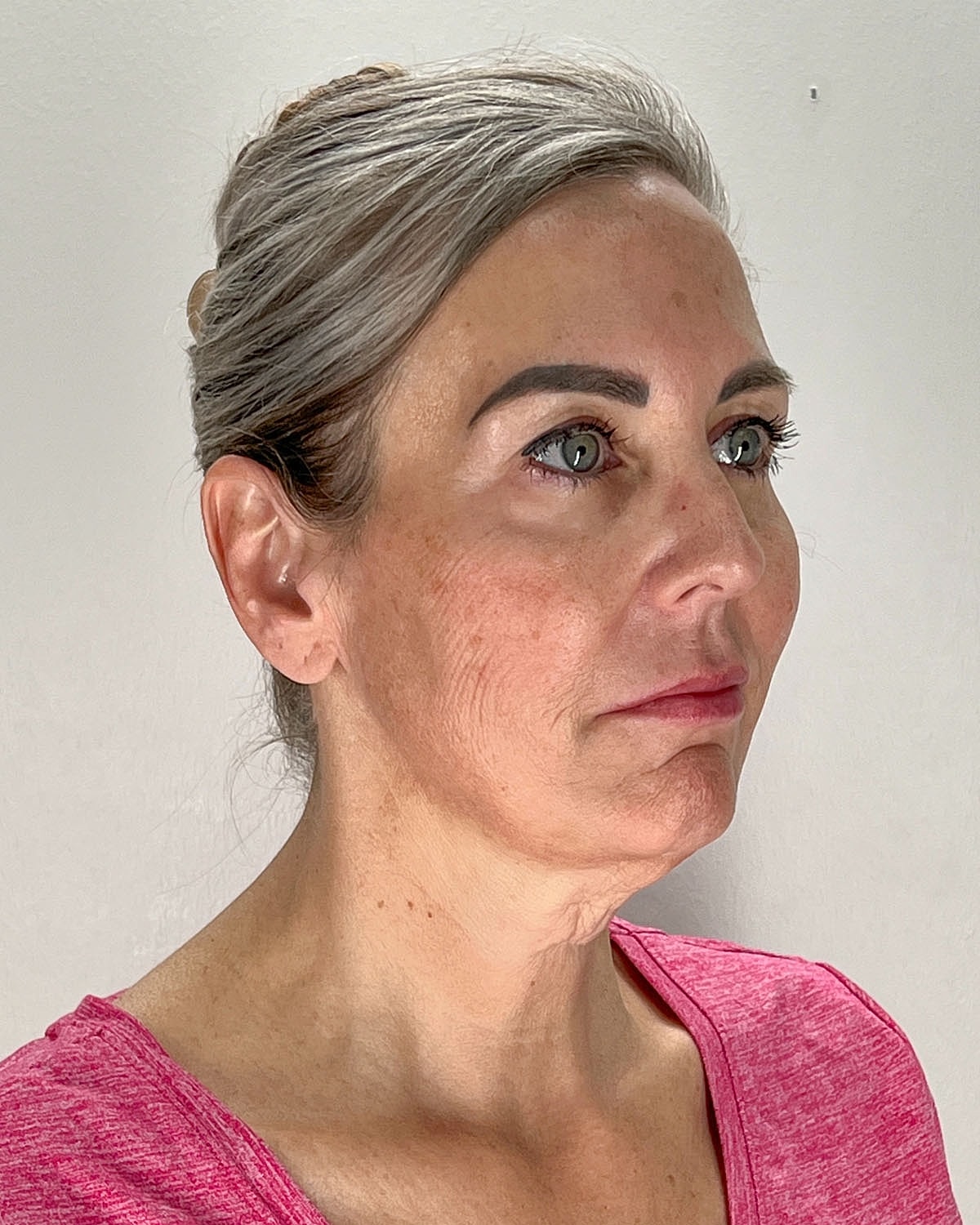 Facelift Gallery Before & After