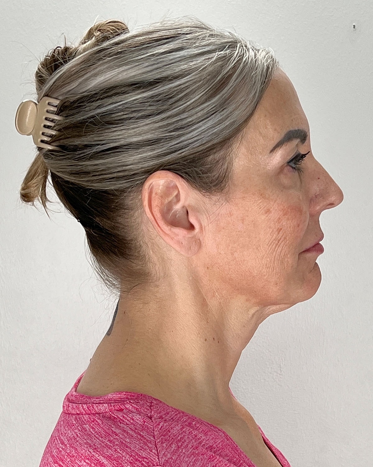Facelift Gallery Before & After