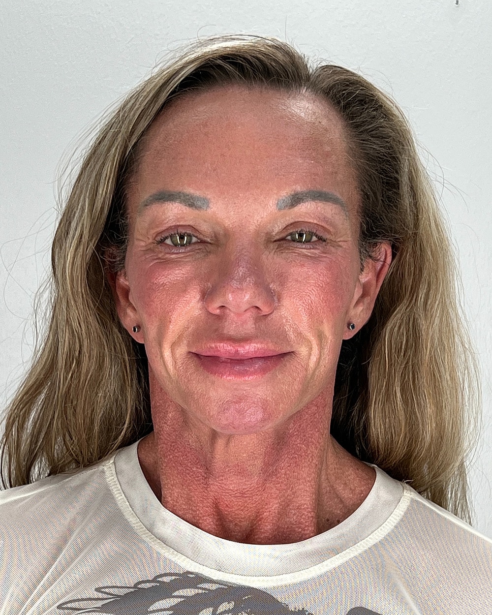Facelift Gallery Before & After