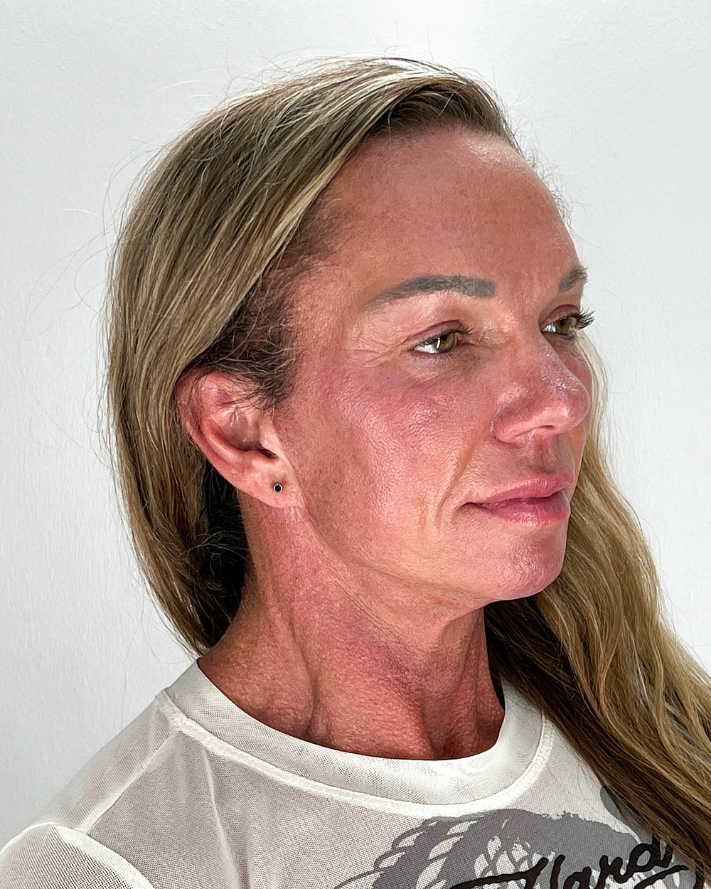 Facelift Gallery Before & After