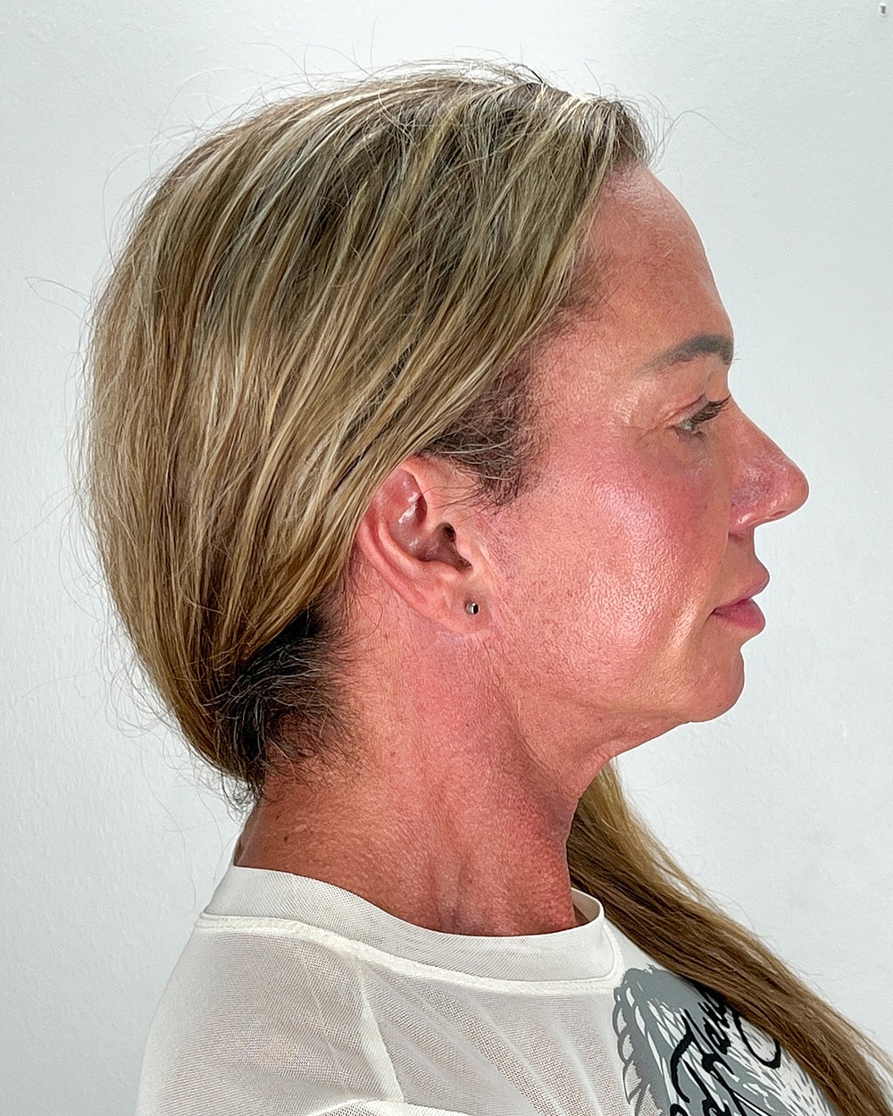 Facelift Gallery Before & After
