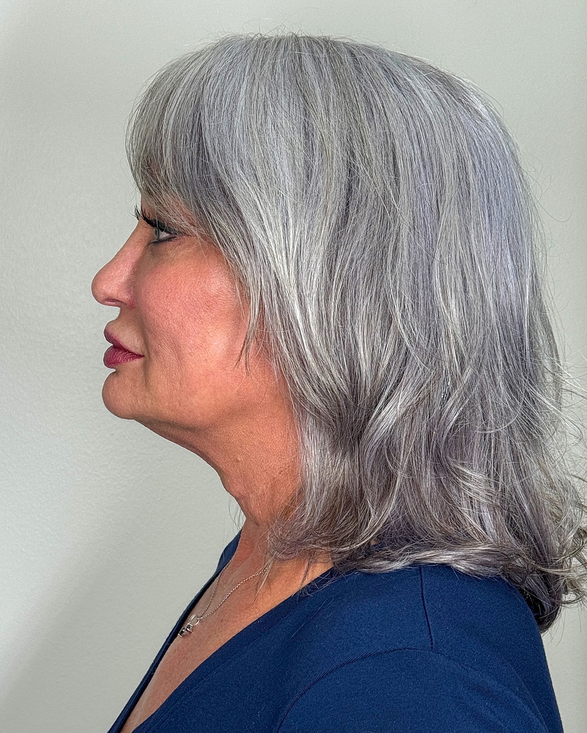Facelift Gallery Before & After